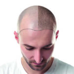 Lisa Rose – Tricopigmentation, l’autre technique contre la perte des cheveux